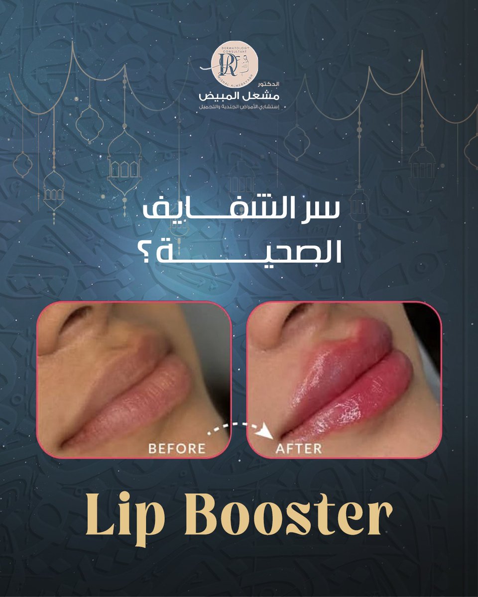 dr_mishal20's tweet photo. مو كل الشفايف تحتاج تكبير واضح.
أحيانًا ترطيب عميق ولمسة امتلاء خفيفة تعطيها مظهر صحي وطبيعي .
تقنية Lip Booster تساعد على ترطيب الشفايف وشد خطوط الشفاه وتحسين نعومتها وإبرازها بشكل طبيعي.
احجزي استشارتك الآن قبل العيد ✨
#السعودية 
#عنايه
#الخبر
#lipbooster https://t.co/uoIxJ2gpdB