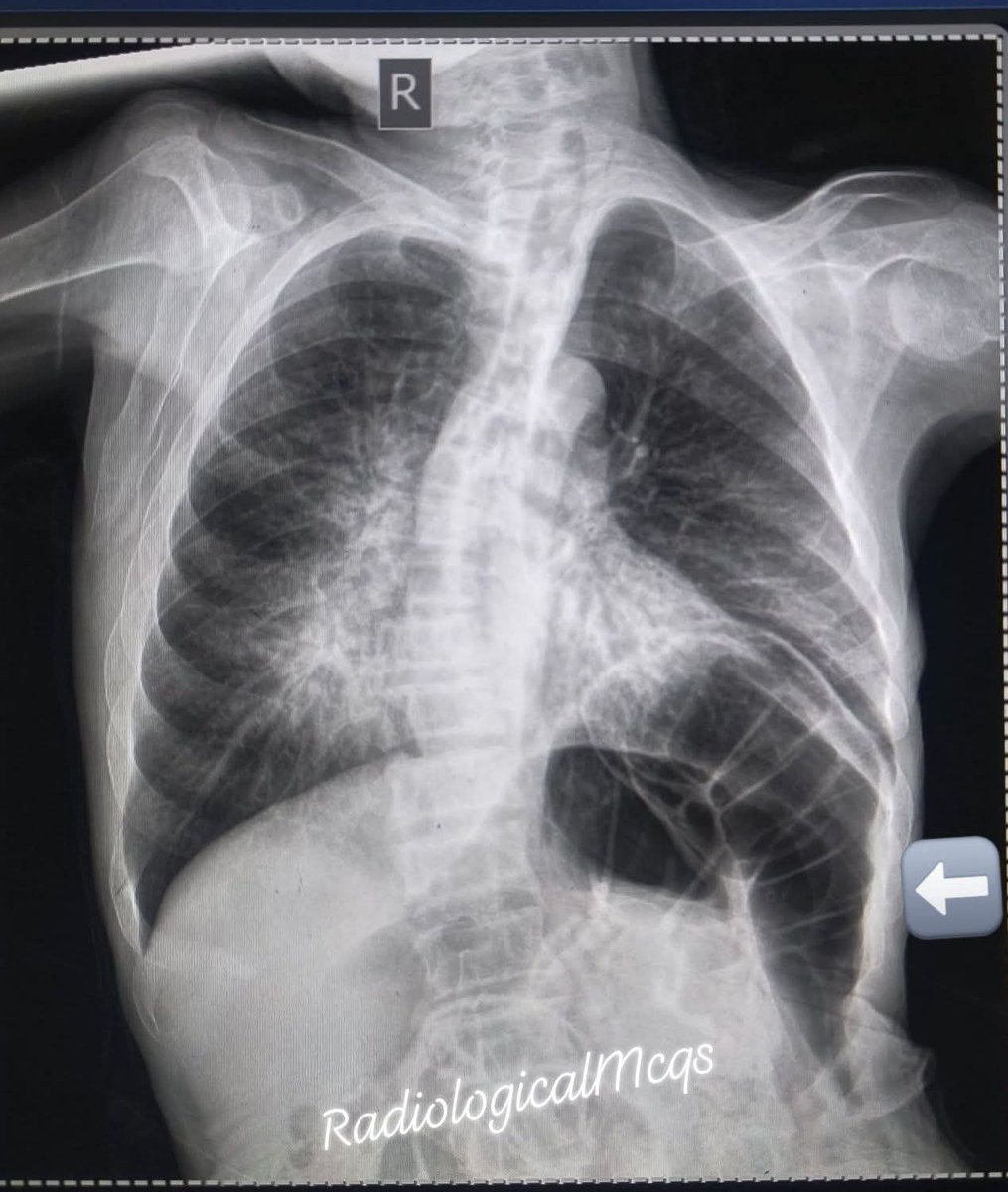 albertoortegana's tweet image. 35-year-old patient presents with shortness of breath and chest discomfort.chest x ray was ordered what are the findings and diagnosis?
#radiology #xray #tuberculosis #health #radiographer #pulmonology #wellness #diagnosis 
@dr_manish_ydv @Dr_Shiv_kumar_ @drobiy12 @DrMedica_13