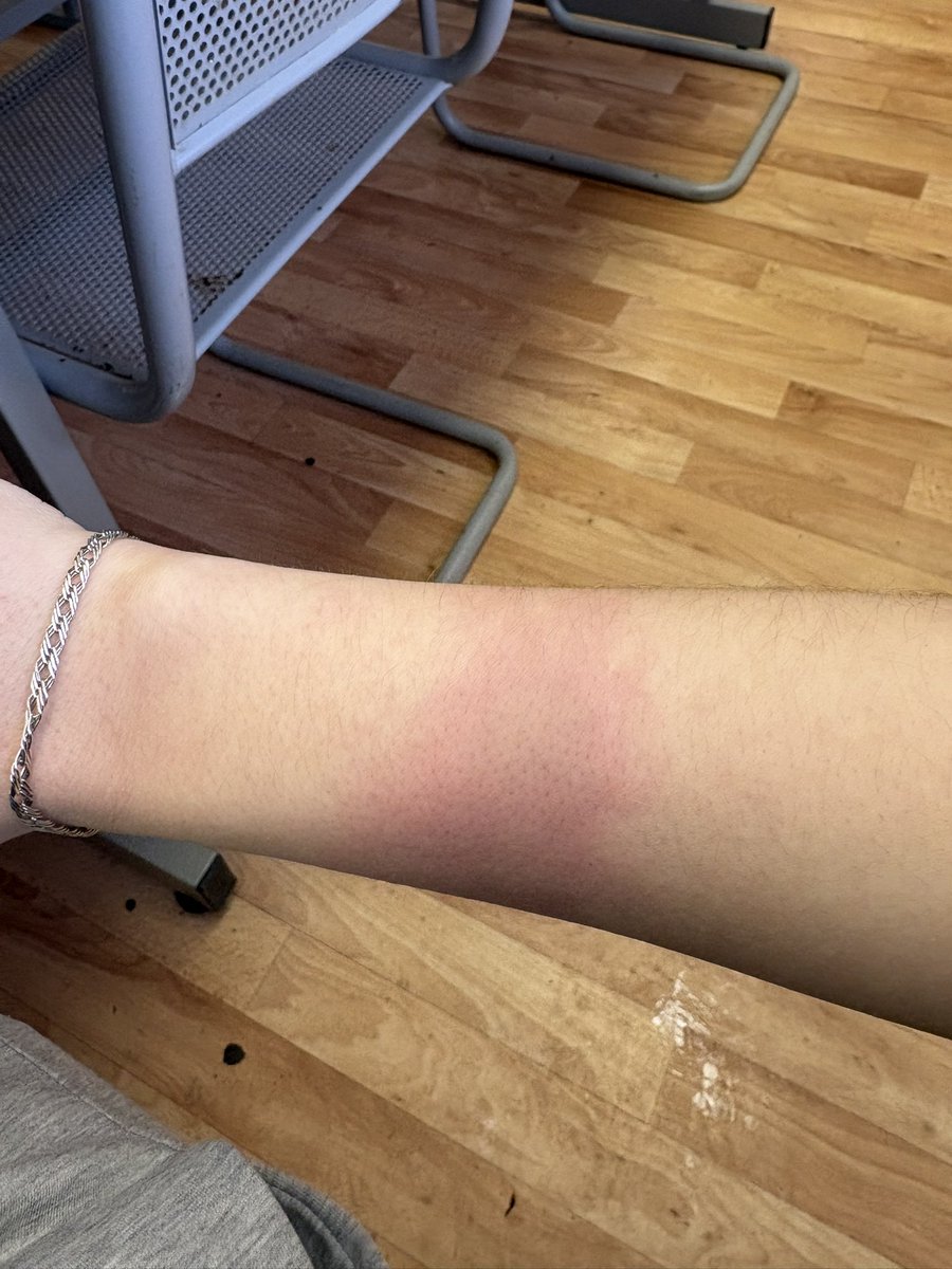 ekattss's tweet photo. В этом году я собираю очень необычную коллекцию..
Коллекцию ожогов на правой руке, чтобы в следующем году плотненько забить рукав💅🏼 https://t.co/tiNEW6fYxi