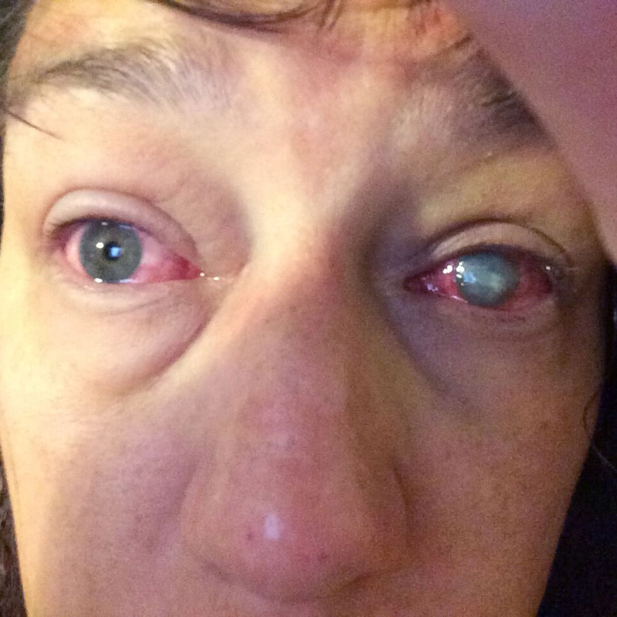 jack_schroder_'s tweet photo. Contact lenses are worse than sunglasses for your health.

You block UVA/UVB light, scatter IR light and convert it into unusable heat instead of mitochondrial respiration, prevent atmospheric oxygen absorption, and block tear film formation (provides oxygen, nutrients, antimicrobial peptides, immunoglobulins — essential for preventing infection and optimizing the turnover of this layer).

This makes the cornea hypoxic and prevents the proper bending of light hitting matter — which enables you to convert it into electricity to drive biochemistry in all of your tissues via circadian entrainment to the hypothalamus and frontal lobes. These regions control your hormones, neurotransmitters, mood/emotions, thoughts, digestion, immune function, detoxification, reproduction, metabolic function, and more.

The solution is to use narrow glasses as much as possible, whilst you optimize your health and eyesight in the meantime.