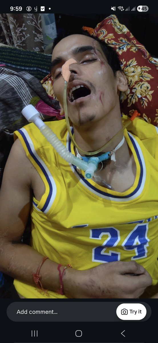 एक मार्मिक निवेदन 🙏🙏
जनपद चमोली के 23 वर्षीय रजत देवली 2024 के एक एक्सीडेंट में अपनी शारीरिक क्षमता खो बैठे हैं , इनकी माता जी ने अपनी सारी जमापूंजी इनके इलाज में लगा दी । आगे के इलाज के लिए मां पूर्णतया असमर्थ हैं और आप सभी से मदद की उम्मीद कर रही हैं कृपया मदद करें 🙏🙏