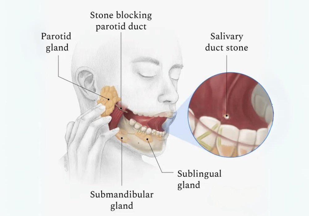 A case of Sialolithiasis on Ultrasound: See the Obstruction in Real Time.

In these ultrasound images, we demonstrate submandibular gland sialolithiasis, a common cause of painful swelling in the floor of the mouth, especially during meals.

Using a high-frequency linear probe,