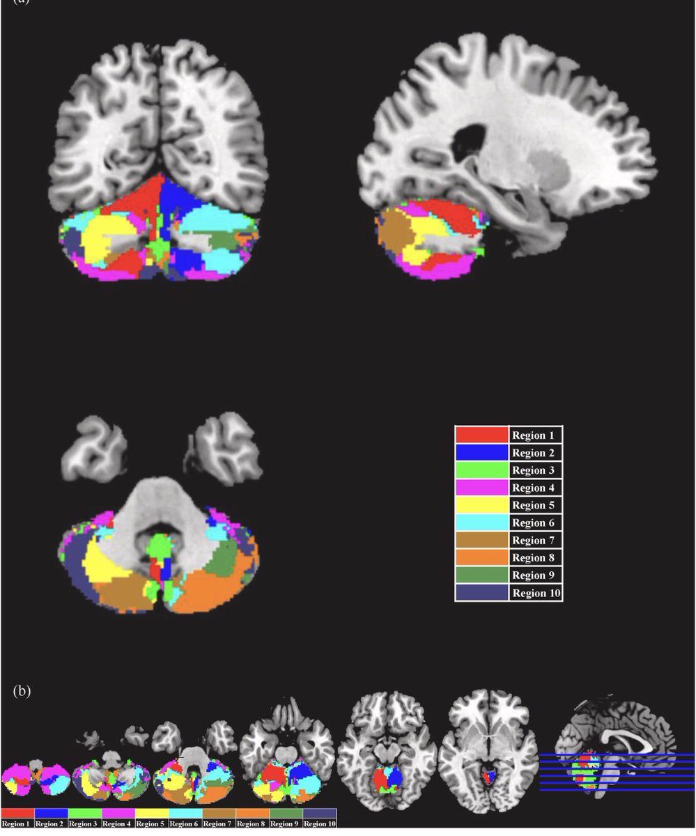 ParkinsonismD's tweet photo. Motor-planning cerebello-cerebral network alterations in PRRT2-related paroxysmal kinesigenic dyskinesia
#motorplanning #cerebellocerebral #network #PRRT2 #PKD
https://t.co/sfAfiGwUbu https://t.co/ueuZMKleFy