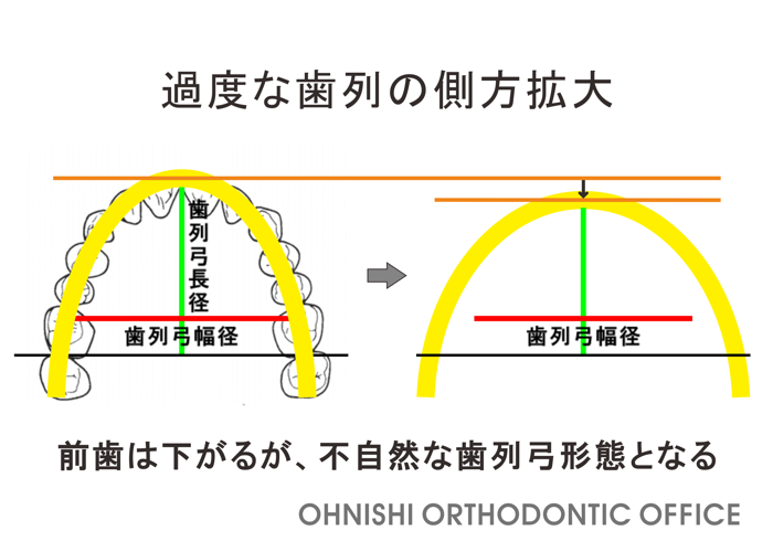 e_hanarabi's tweet photo. 矯正つれづれ叢に「歯並びを広げると、口元が下がるという誤解」を追加いたしました。
https://t.co/zuvcAM6hzT https://t.co/sbBVk3mCde