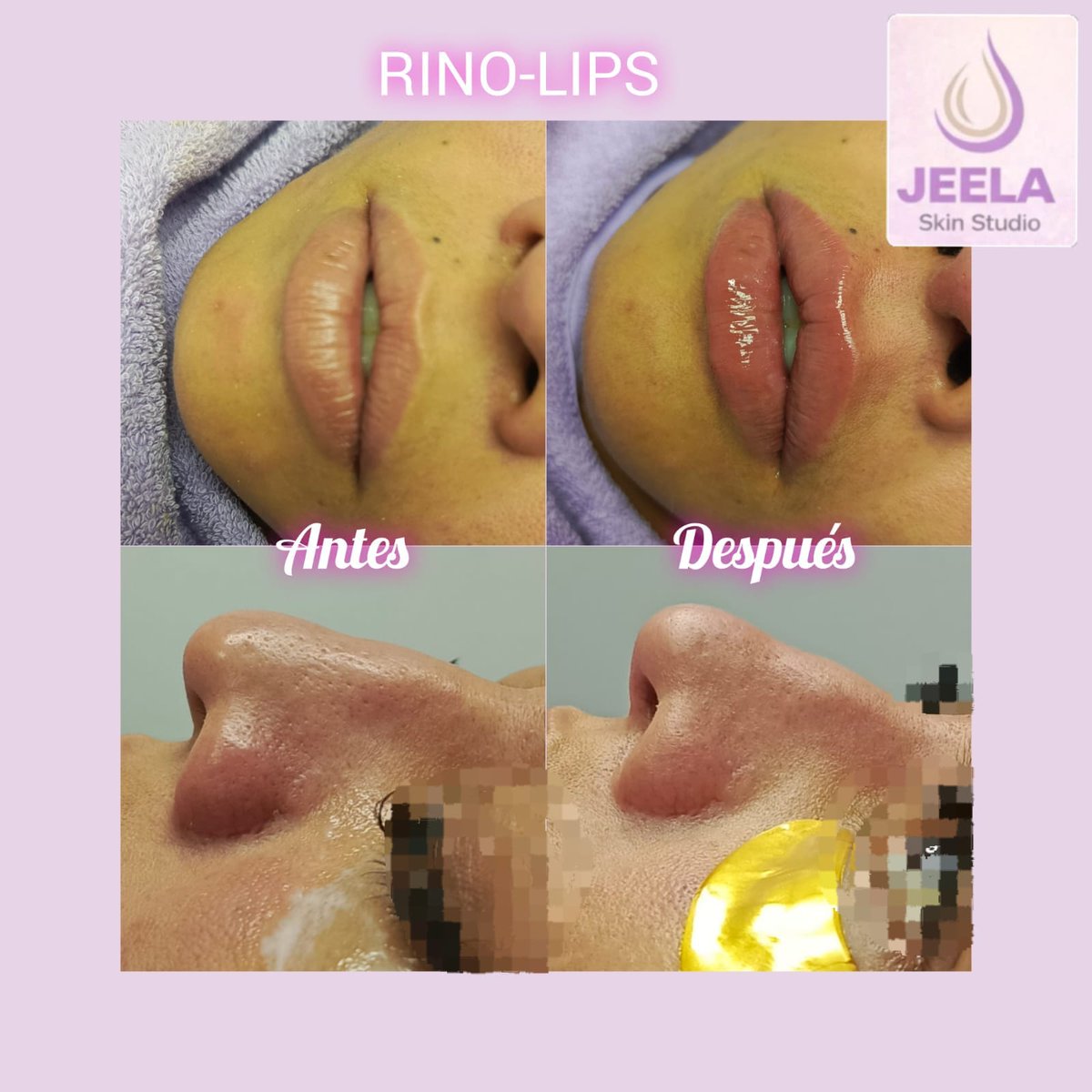 SkinStudioJeela's tweet photo. ✨ RinoLips: armoniza tu perfil sin cirugía.
Mejoramos la forma de la nariz y el volumen de los labios para un resultado natural y equilibrado.

#Rinolips #ÁcidoHialurónico #ArmonizaciónFacial #JEELASkinStudio #BellezaNatural https://t.co/BEeGiL9391