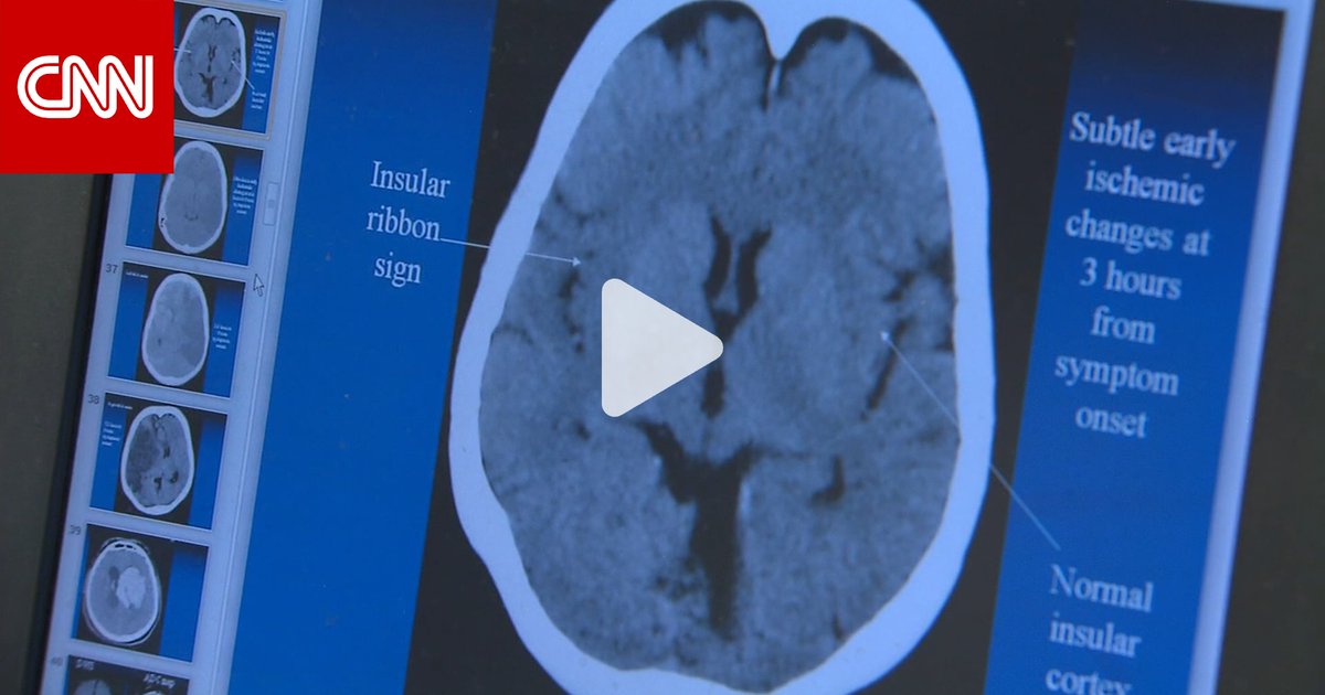 التعب والهبّات الساخنة وتغيّرات المزاج.. كيف نميّز بين أعراض سنّ اليأس والتصلّب المتعدّد؟ 