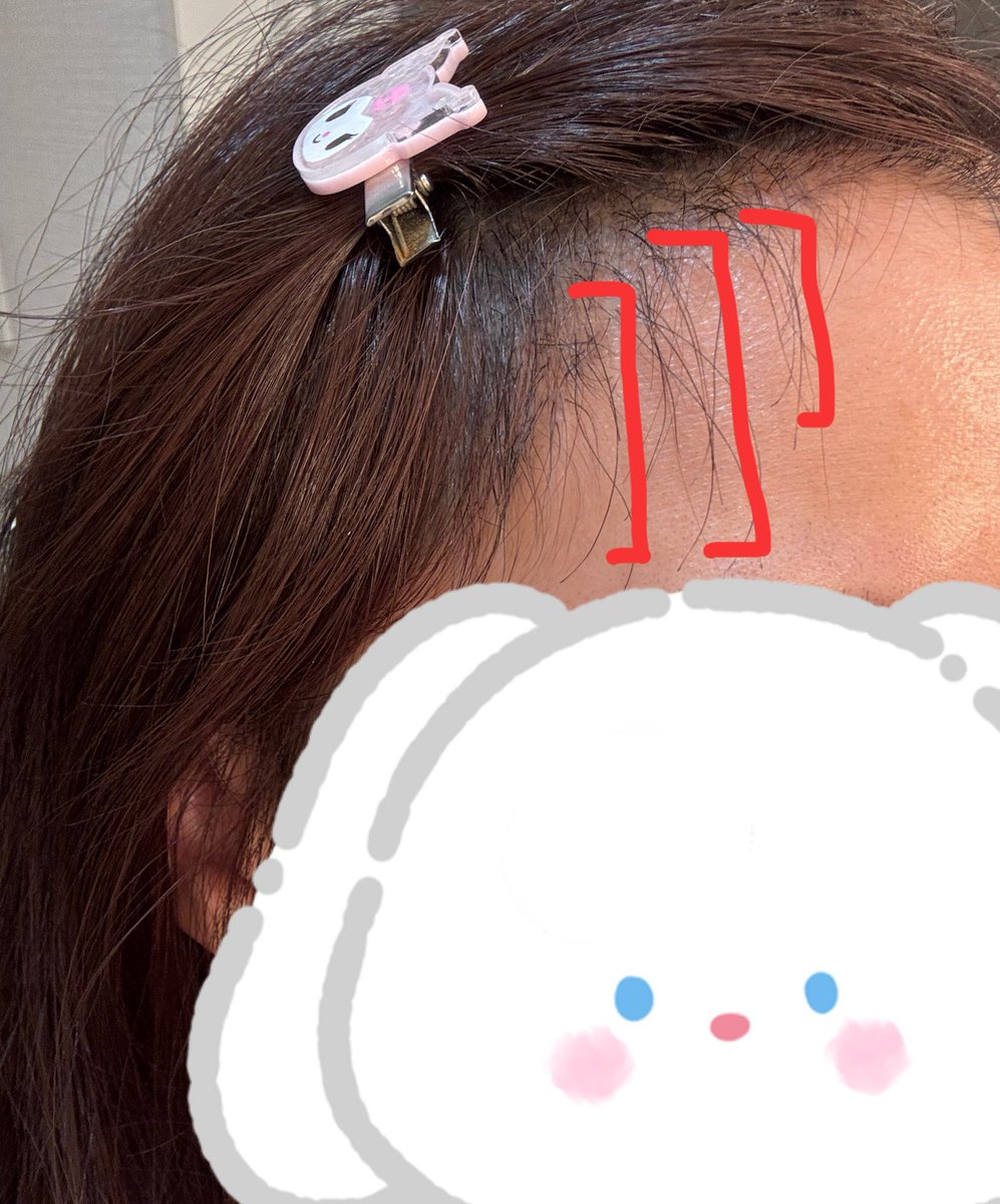 rimelo_9's tweet photo. @okaypsjpn 🌼植毛施術レポ3ヶ月目
💇‍♀️チョンダムok整形外科
📷写真は施術後約3ヶ月目です https://t.co/ruZqx6BhLt