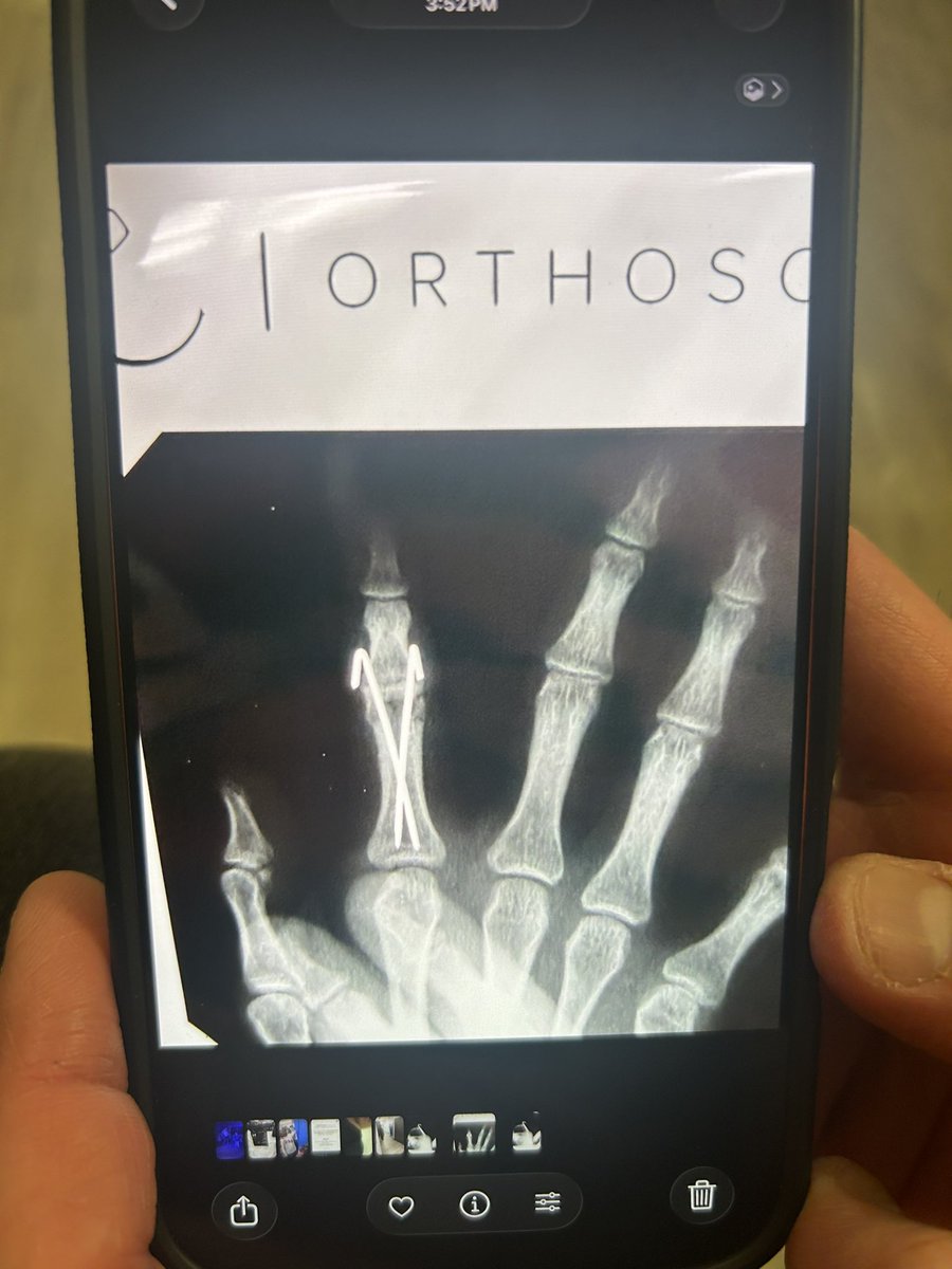 Ballou_B_'s tweet photo. Suppose to be out 4-6 weeks. My girl said- “I’m playing.”
2 weeks after surgery she took those pins out and gave it all she had. She loves her team, her coaches and all of SHS fans. She played her heart out for each of you. She’s selfless but in my eyes she’s freaking LEGENDARY! https://t.co/tOvliHgAHy
