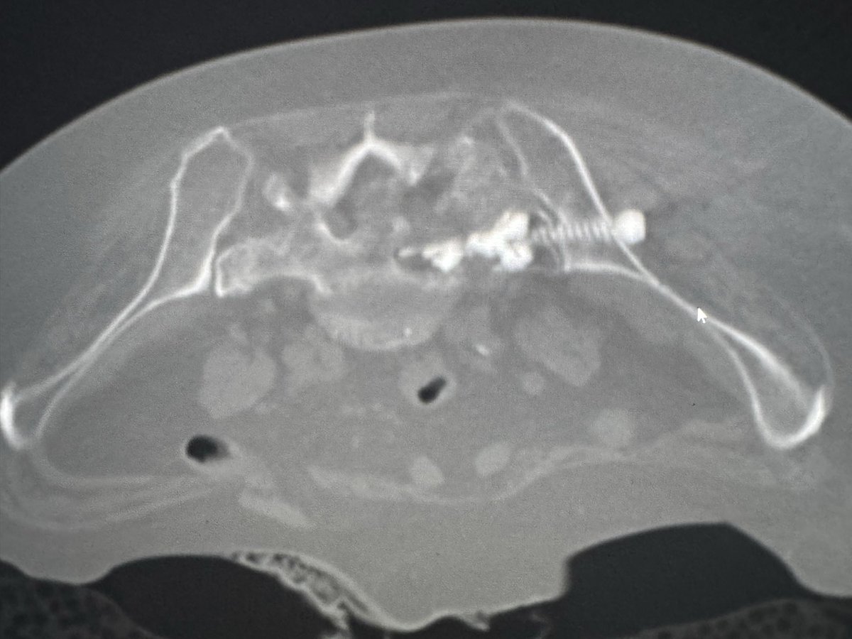 DoctorCliffyy's tweet image. mCHOLANGIO 3.5cm, path Frx, motor intact, mild sensory involved
RFA (2x probes stacked and 2 burns each) One PEF probe near S1 @Medtronic 
S1 TNT @siboneinc 8.7x150mm
4-5cc cementoplasty (interDigit into Frx and help reinforce hardware)

#IR #MEDtwitter #Cancer #MSK #BONE