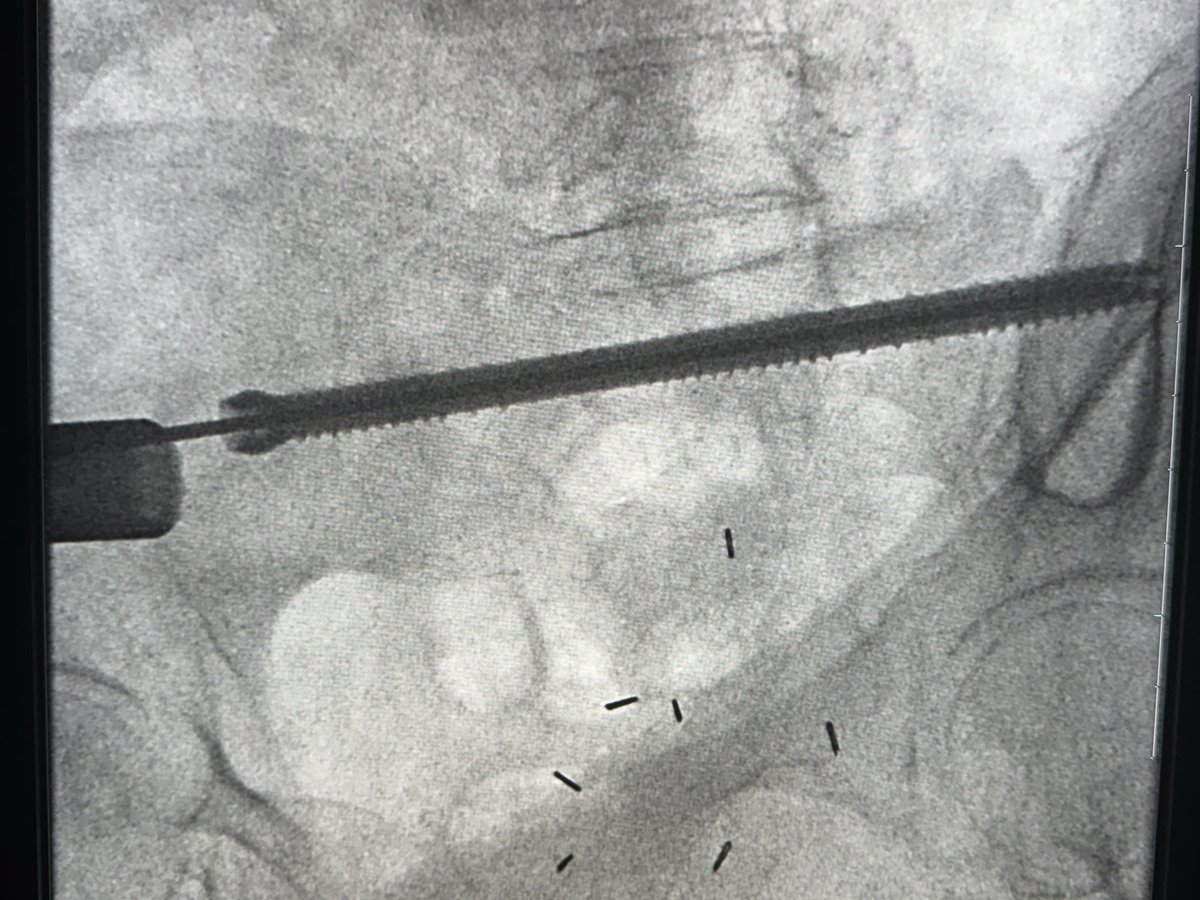 DoctorCliffyy's tweet image. mCHOLANGIO 3.5cm, path Frx, motor intact, mild sensory involved
RFA (2x probes stacked and 2 burns each) One PEF probe near S1 @Medtronic 
S1 TNT @siboneinc 8.7x150mm
4-5cc cementoplasty (interDigit into Frx and help reinforce hardware)

#IR #MEDtwitter #Cancer #MSK #BONE
