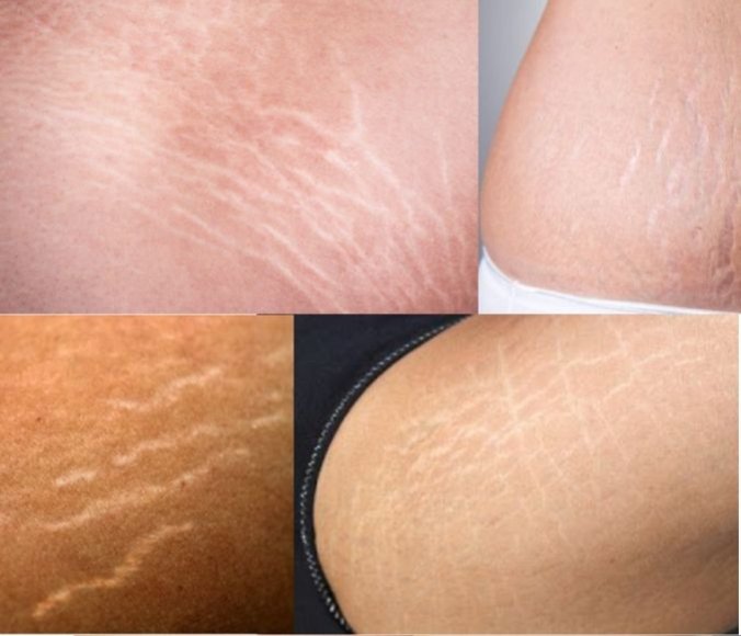 herbasics's tweet photo. JANGAN PERCAYA KALAU STRECMARK BISA HILANG!!! 

Faktanya, stretch mark nggak bisa hilang 100%, karena itu bekas kerusakan elastisitas kulit. https://t.co/tLK6LbwAqo