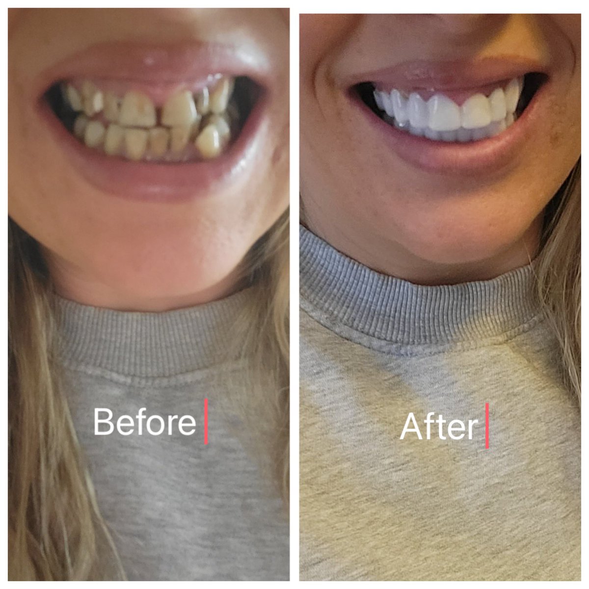 NeedThatSmile__'s tweet photo. Order your new smile today from £199 shop now https://t.co/P6zc5bTqZx #clipinveneers #cliponveneers #needthatsmile #veneers #uksmile #newteeth #clipins https://t.co/MhwmJPiRSS