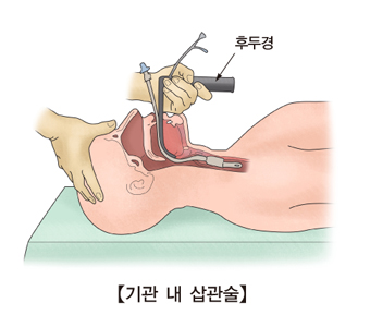 emdoc1988's tweet photo. "이게 뭘까요?"

다시 보니 "똥"처럼 생겼지만,
실제로는 환자의 성대 옆에서 끄집어낸 생약성분의 환입니다.

어제 80대 남성분께서
무슨 환을 먹다가 잘못삼킨 이후로 목의 이물감이 심해 응급실에 오셨습니다.

제가 근무하는 응급실엔 이비인후과 장비도 없고, 그렇다고 목의 이물로 응급내시경을 할 조건은 아니라 대학병원으로 안내 드릴까도 싶었으나, 
요즘은 대학병원도 이비인후과 당직이 없는 경우가 많고, 바로 처치가 안될듯 하여 일단은 검사를 해보기로 했습니다. 

이물의 위치를 확인하기 위해 목 CT를 촬영했고
이물은 식도가 아닌 기도의 성대 옆 pirifom fossa쪽에 위치해 있었습니다.

정상적인 방법으로는 꺼낼 도리가 없어 궁리하던 차에..
기관삽관을 위한 장비들을 사용하여 한번 꺼내보기로 했습니다.

혀를 뿌리부터 밀어 올릴수 있는 laryngoscope장비를 이용하여 혀를 밀어 올리고, 성대가 들어나게 위치시킨다음
길다란 forcep을 이용하여 성대 옆 주머니에 들어있는 이물을 제거할 수 있었습니다.

글은 이렇게 간단하지만..
실제로는 환자도 힘들고, 이게 될지 안될지도 모르는 의료진들도 등에 땀이 흐르는 상황이었습니다.

다행히 제거는 잘 되었고,
남은 잔여물도 suction으로 잘 뽑아 드렸습니다.

최근 중심정맥관 제거를 하던 중 발생한 심정지로 설명의 의무를 다하지 않고 했다고 배상판결 받은 판례를 보았는데,
이러한 시술을 하는데는 어떤 동의서를 받아야 할까요?
단순한 이물의 제거라 생각 할 수 있겠으나, 심한 구역반사가 일어나는 과정중에 저혈압, 서맥 등이 발생하건, 기도 흡인 문제가 생길 수도 있습니다. 당연히 치명적일 경우 잘못될 여지도 있습니다.

환자가 잘못되길 바라며 처치하는 의사는 없다고 생각합니다.
적어도 제가 같이 일하는 의사분들 중 그런분은 본적이 없습니다. 모두 착한 사람들이라고 하긴 어렵지만 악의를 가지고 진료를 하는 사람은 없다는 겁니다.
우리 사회가, 그리고 사법부가 의사를 부정적인 시각으로 바라보지 말았으면 합니다.