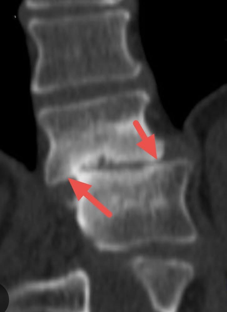 hemo_shk's tweet image. #MCQ

What is the diagnosis?

1.Anterolisthesis

2.Retrolisthesis

3.Laterolisthesis

4.Spondylolisthesis