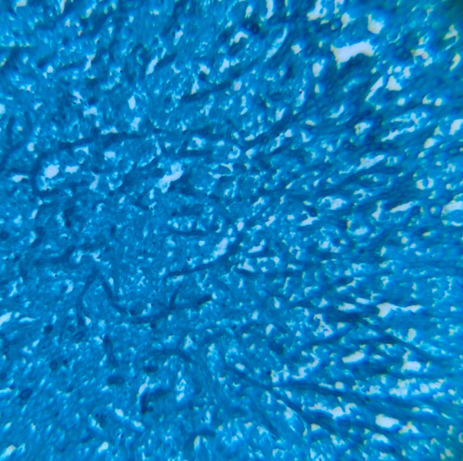 DiBellaMD's tweet photo. 🍄 Cancer… or fungus?

A nodular skin lesion in a kidney transplant patient raised suspicion for malignancy.
🔬 Grocott-Gomori staining revealed the real culprit → rare cutaneous Scedosporium infection.
👏 Great work by Dr Martin Iurilli & colleagues.
⚠️ Take-home: biopsy early. Think beyond cancer.

📖 Case 👉 https://t.co/GXkVMk8sRX
#InfectiousDiseases #MedMycology #Transplant #ClinicalReasoning