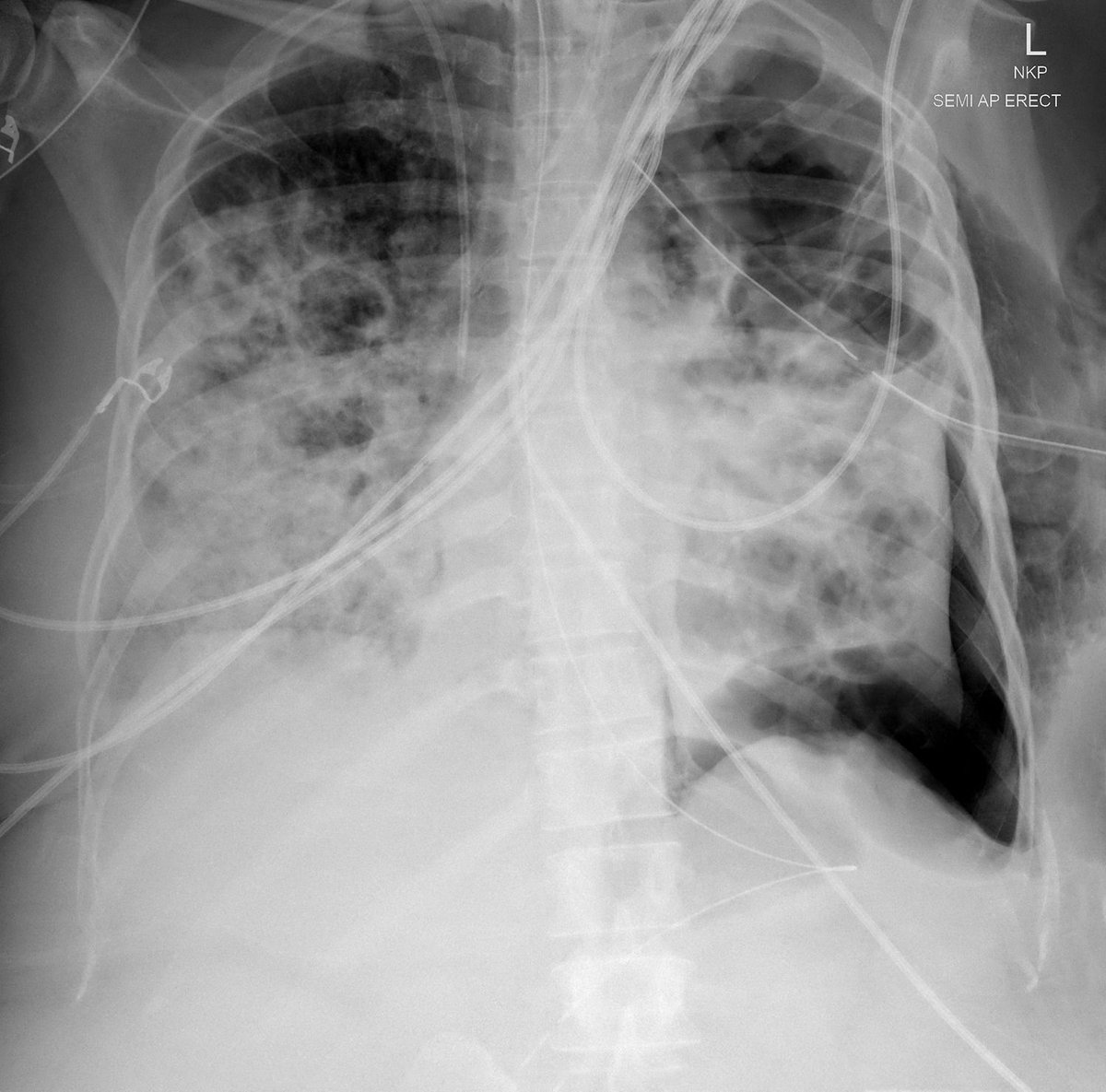 BJAJournals's tweet image. 🩺 Bronchoscopy can be pivotal in persistent air leak:
🔹 identify a bronchopleural fistula
🔹 localise the culprit segment with balloon occlusion
🔹 guide endobronchial valve placement
Read more in the #BJAEd: bjaed.org/article/S2058-…
#Bronchoscopy #ICU