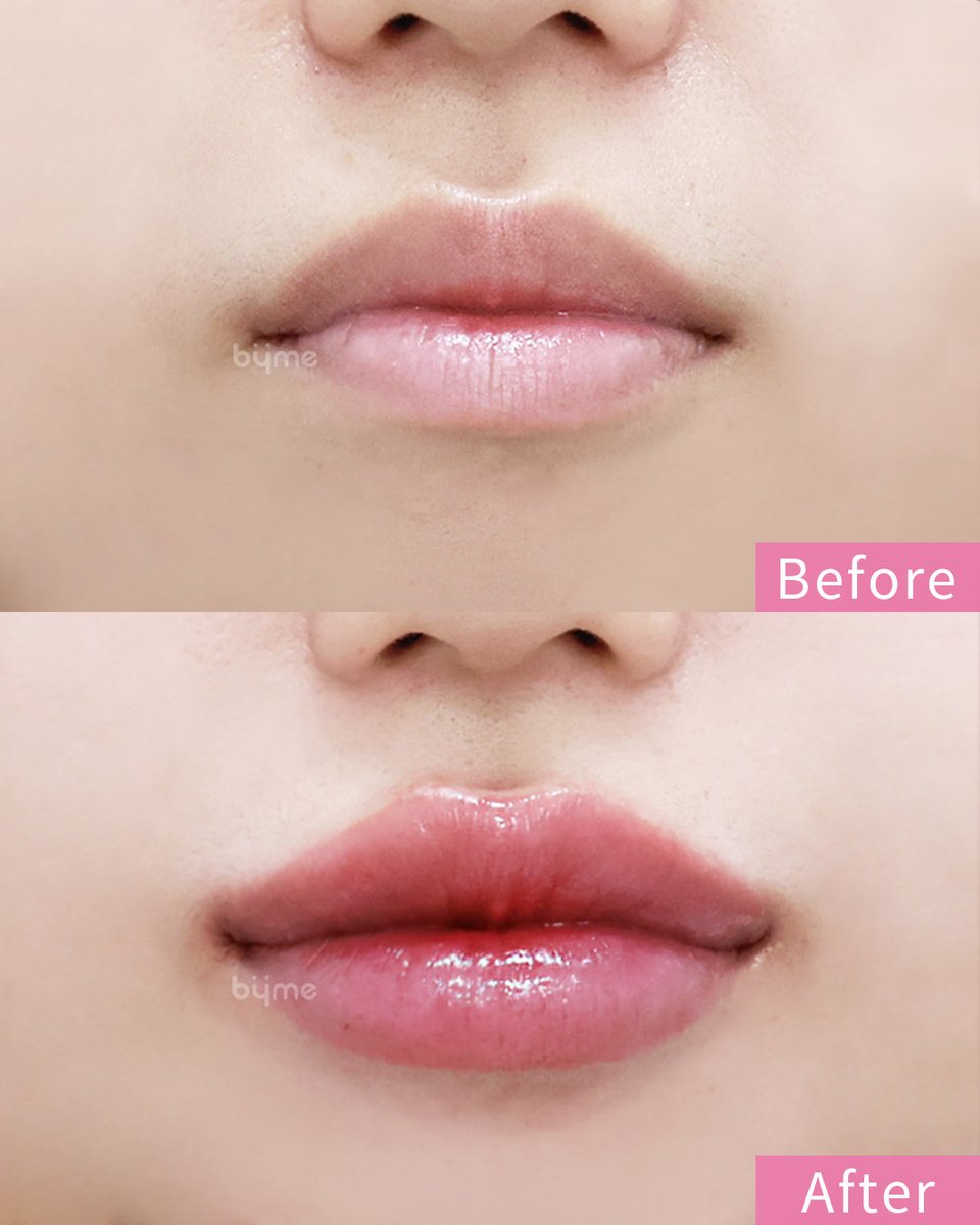 BymePs's tweet photo. 唇ヒアルロン酸(唇フィラー) 🩷 Before / After

📍バイミ美容整形外科
✓担当医：チェ・ハンメ 代表院長
✓施術時間:10-15分ほど
✓持続期間:1-2年ほど(個人差あり)

「自分に似合う形がわからない」
そんな方も、どうぞお気軽にご相談ください。

お一人おひとりのお顔立ちに合わせて、
自然なバランスでデザインいたします。
.
.
ご相談やご予約は、お気軽に公式LINEまで💌
https://t.co/KSFqA4wb6A