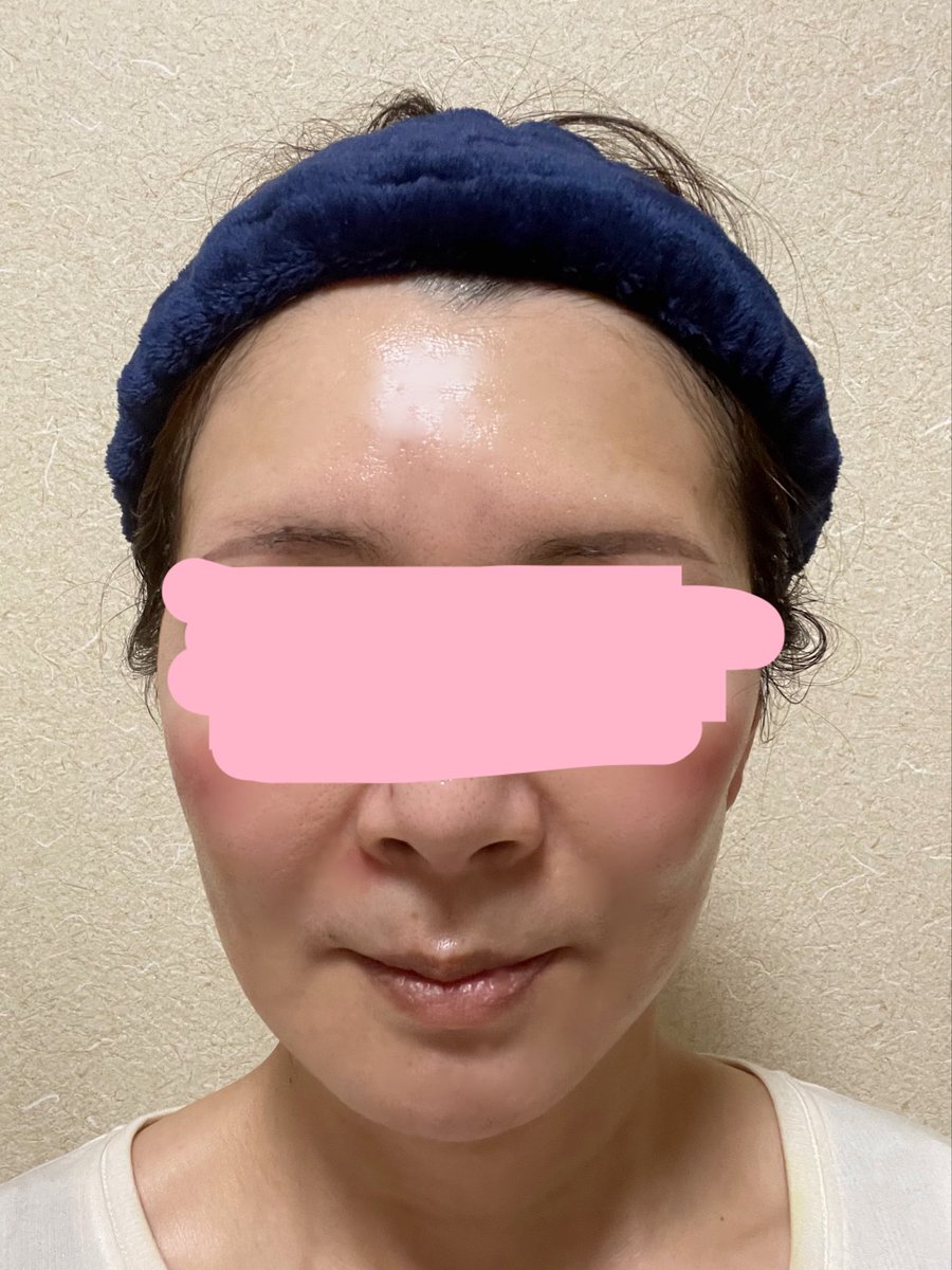 kiko 切開リフトDT中 tweet media