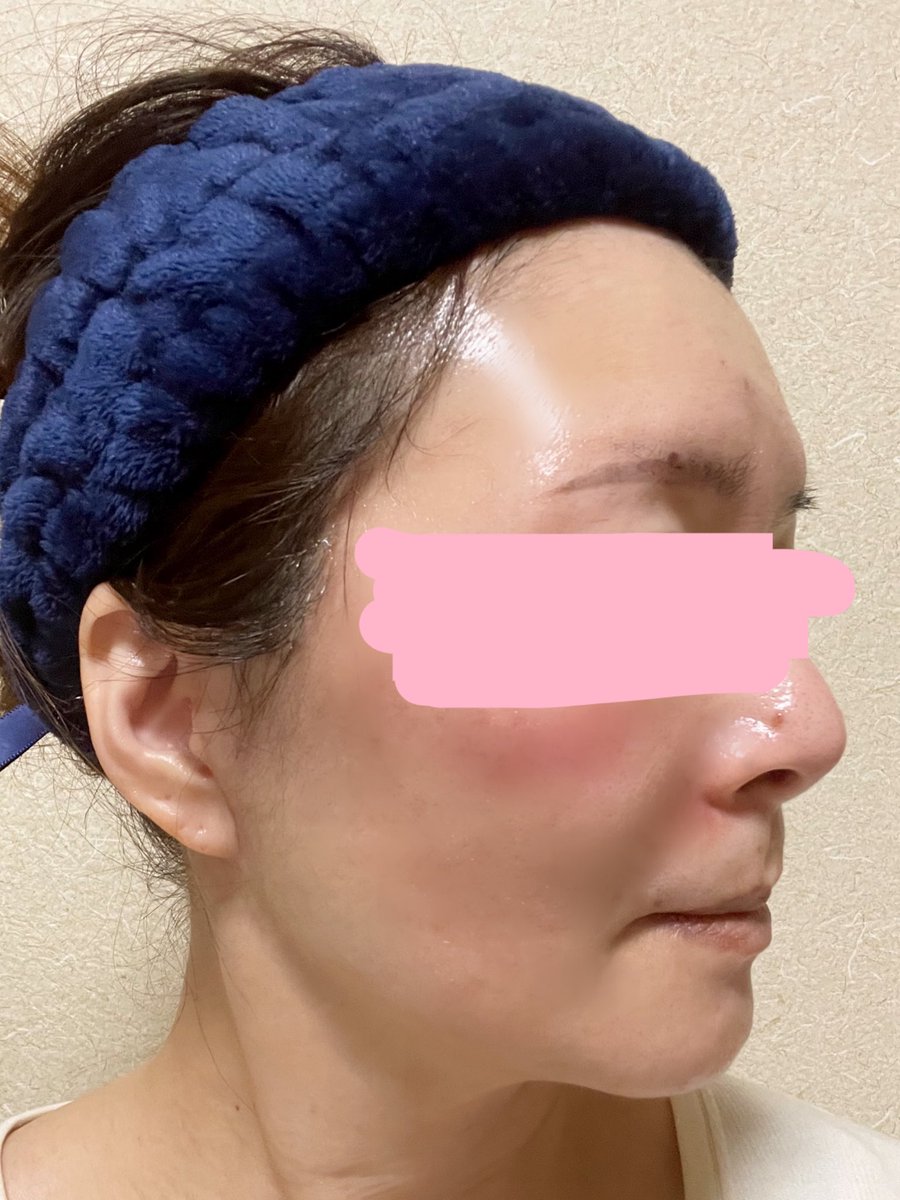 kiko 切開リフトDT中 tweet media