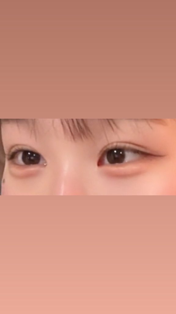 VdZd5's tweet photo. ←before      after→
 #埋没 #目頭切開 #裏ハムラ #涙袋脂肪移植 https://t.co/pRTe1QwtR9