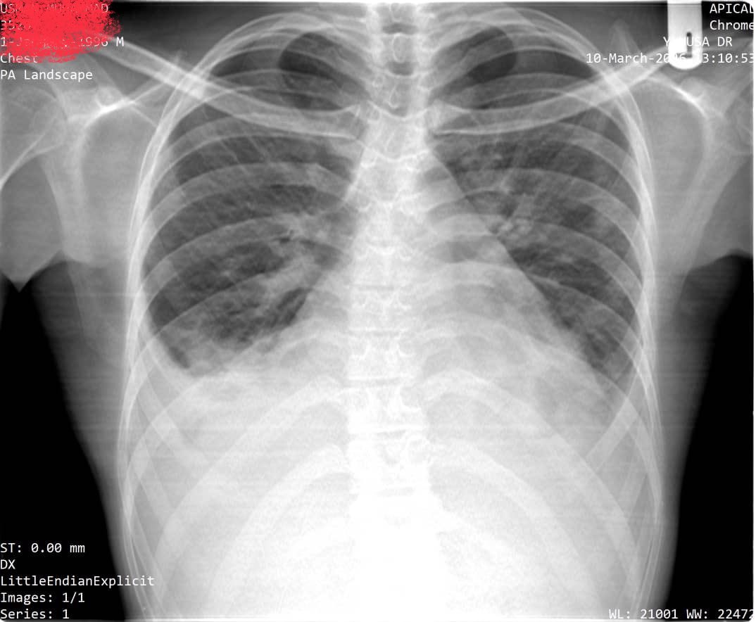 DrAyubaD's tweet image. 30yrs old Man with chest pain and difficulty in breathing!

What do you think is going on?

A. Chest infection
B. Pleural effusion
C. Pneumonia
D. Cardiac failure
#clinicalmedicine #clinical #Radiology
