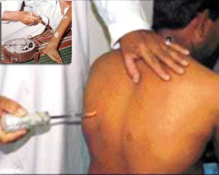 ما رأيكم بالكي بالنار  🔥وهل قد جربتم وما هو حكمه جائز ام لا🤔
عن نفسي ما قد جربت  ولا بجرب