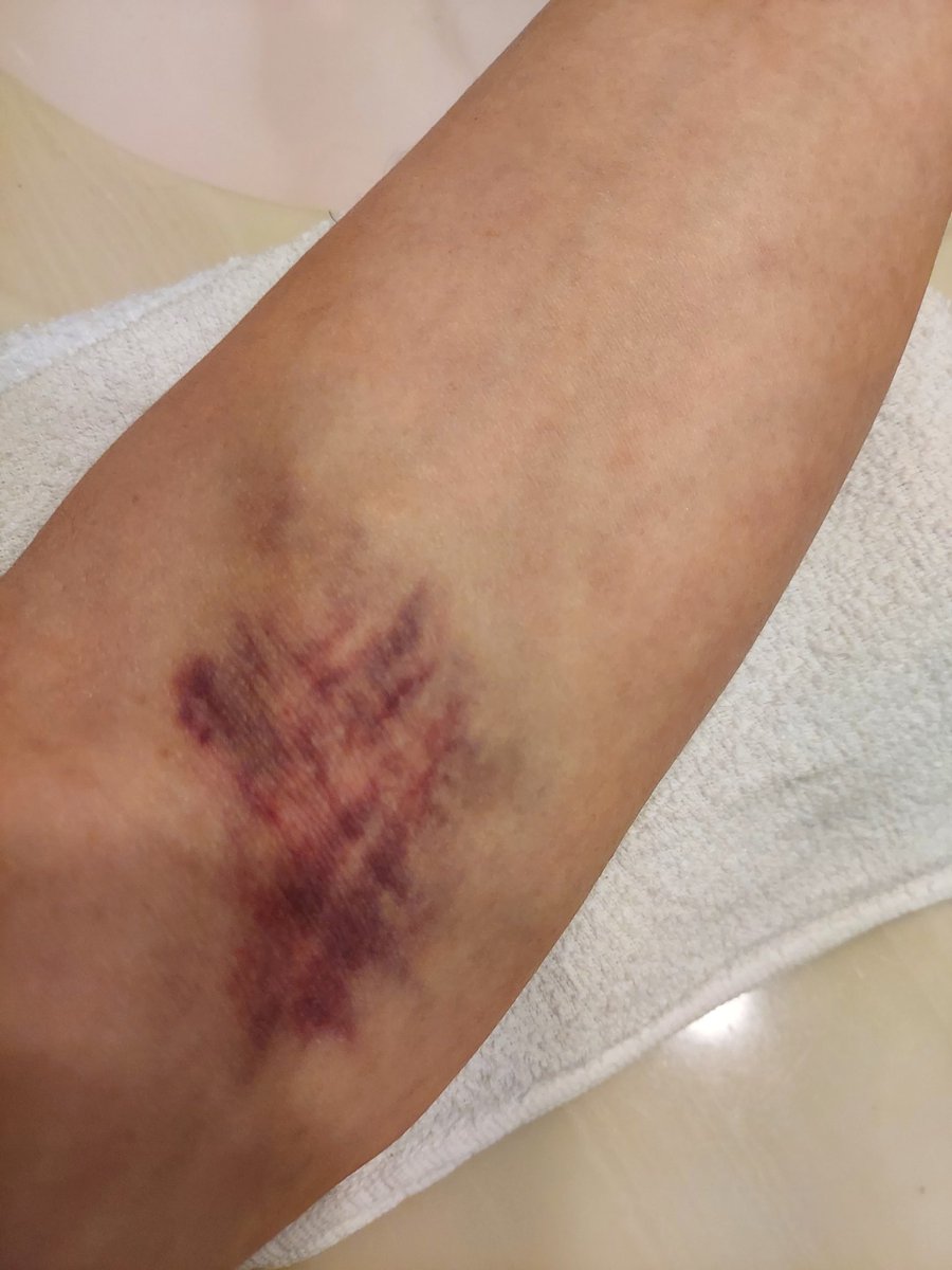 Dr_slump_tendon's tweet photo. あの下手くそナース！💢 https://t.co/izt89RoHk4