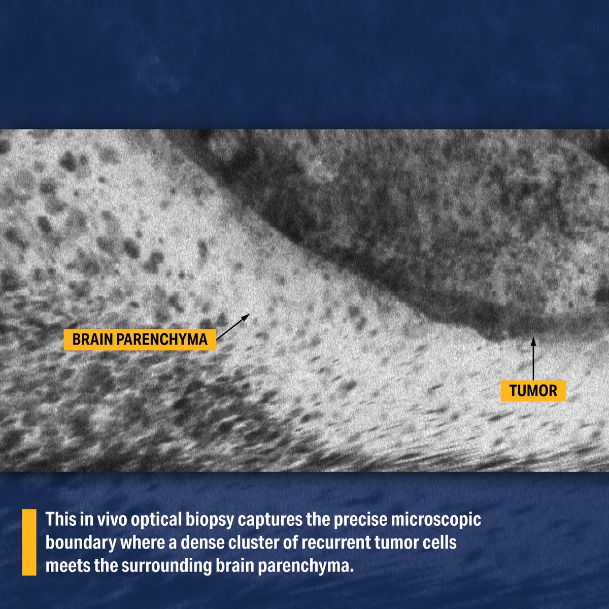 PittNeurosurg's tweet photo. @UPMC Visualizing tumor-brain boundaries, differentiating neoplastic infiltration from white matter fiber tracts, and identifying 5-ALA fluorescent tumor cell clusters at the cellular level.

Click on each image to view more. https://t.co/VgD9FZiUui