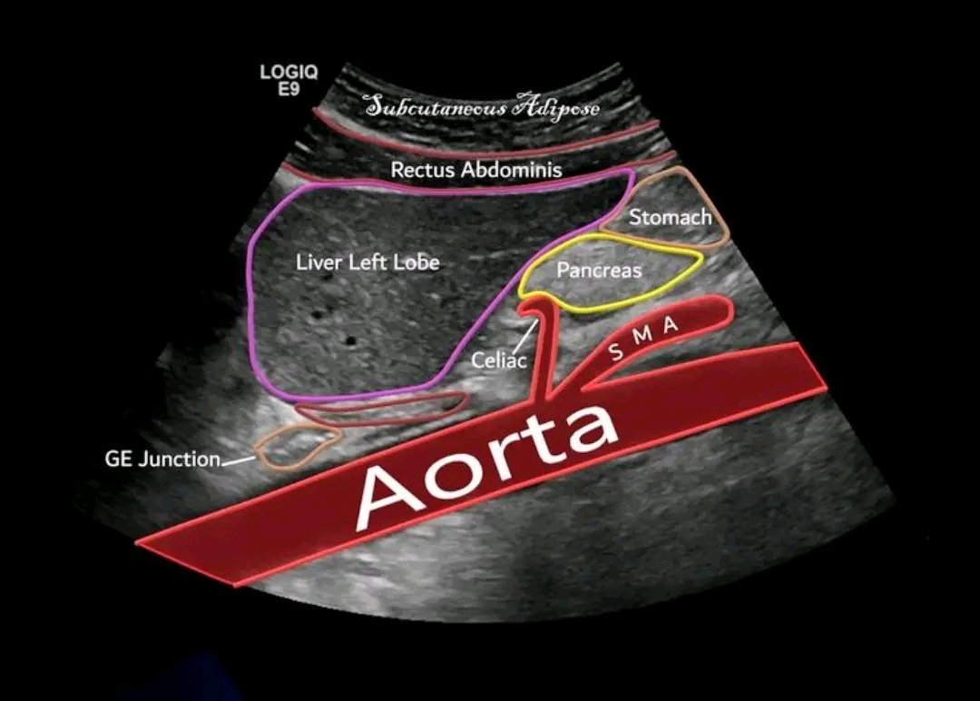 mznljrdy47597's tweet image. Abdominal sonography 

#ultrasound #ultrasoundscan #ultrasoundtech  #radiologist