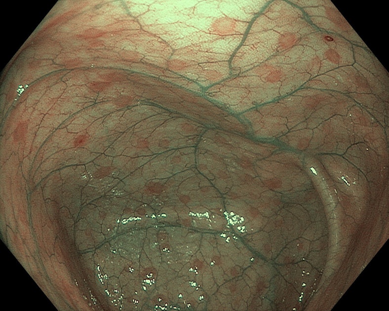 EndoCollab™ | GI Endoscopy Community tweet media