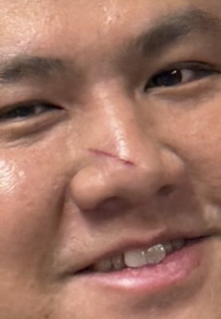 2針だけのブラックジャック