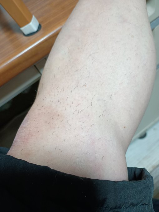 この前買った擦って脱毛するやつ、毛が伸びてきたので使ってみたけど・・・思うような感じじゃなかったので、結局お風呂でシェーバー使って剃った😟。もっと楽に擦り取れるとばかり。今度はあまり伸びる前にやってみるか。 