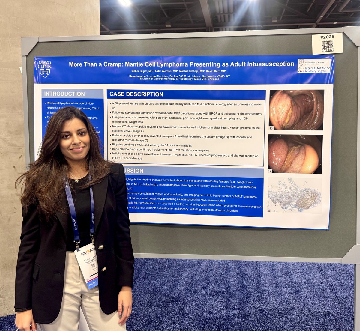 GujralMeher's tweet photo. A small bowel MCL case at ACG 2025 caught me off guard. Months later, I still think about the questions it raised about patients, care, and what I didn’t know. This year, I’m excited to see what lessons ACG 2026 leaves me thinking about! #GItwitter #ACG #Gastroenterology https://t.co/yQydgwlCrF