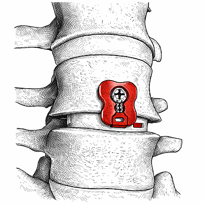 10 Anterior Buttress Plates to Know…! | Updated 2026
thespinemarketgroup.com/10-anterior-bu…