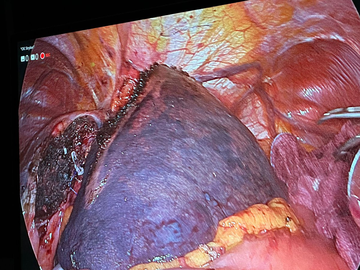 salo75's tweet photo. Laparoscopic liver left lobectomy for CLRM Mets. And in a few days I will be gladly joining my friend Benedetto Ielpo at @HpbMar for a day of learning new techniques and devices https://t.co/iyXFxrlhlB