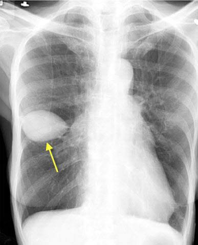 A Patient with heart failure.
What has happened?