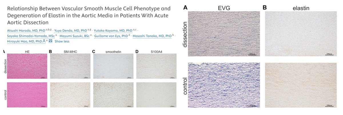 HaoYin20's tweet photo. Loss of contractile phenotype (⏬SMMHC SMTN ⏫S100A4 MMP2) of #SmoothMuscleCell & Elastin fiber in #AcuteAorticDissection
Type A/B? Any aneurysm?🧐
24 case (non-monogenic) vs 17 control
"aortic wall adjacent to the entry site of the dissection"
#AortaEd
#CJCOpen 2025 @CJCJournals
https://t.co/uYk64cABug