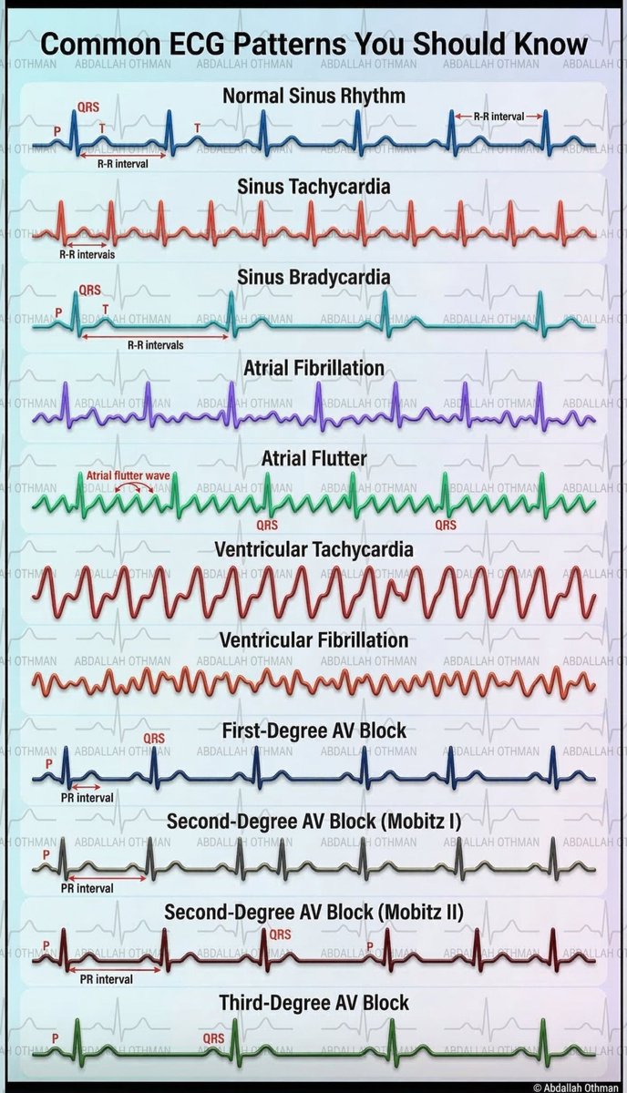CardioBeat_'s tweet image. facebook.com/share/p/17E487…
🫀Essential ECG Patterns
#ECG #Cardiology #EKG #Arrhythmias #AVBlock #CardioEd 📊❤️