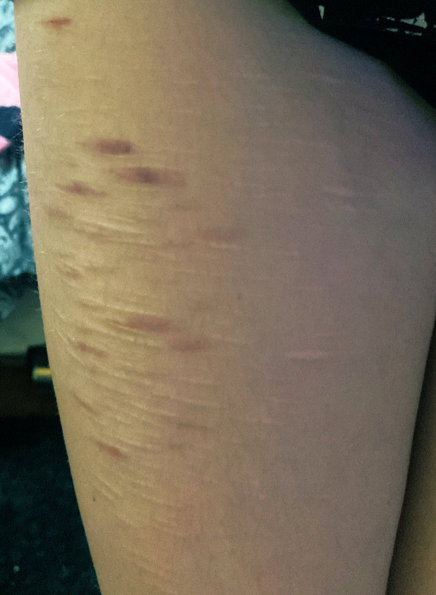 55buckshot's tweet photo. thigh scars happy fun yay https://t.co/DXtuxWcI9i