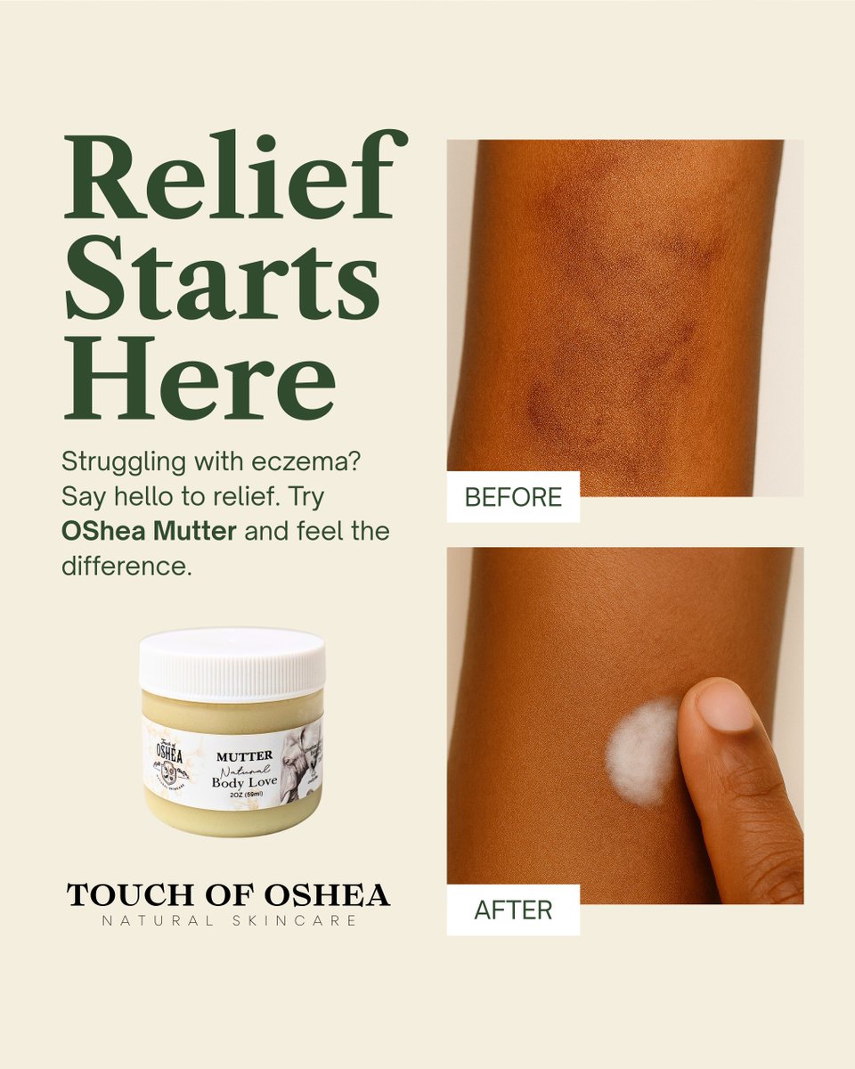 touchofoshea's tweet photo. Eczema acting up? 🌿 Relief is just a balm away.

Say goodbye to itch, dryness, and flare-ups—OSHEA Mutter is made with 100% natural ingredients to soothe, calm, and deeply hydrate irritated skin.

✨ Gentle enough for daily use.
✨ Powerful enough to bring real results. https://t.co/tD0Rl1l86x
