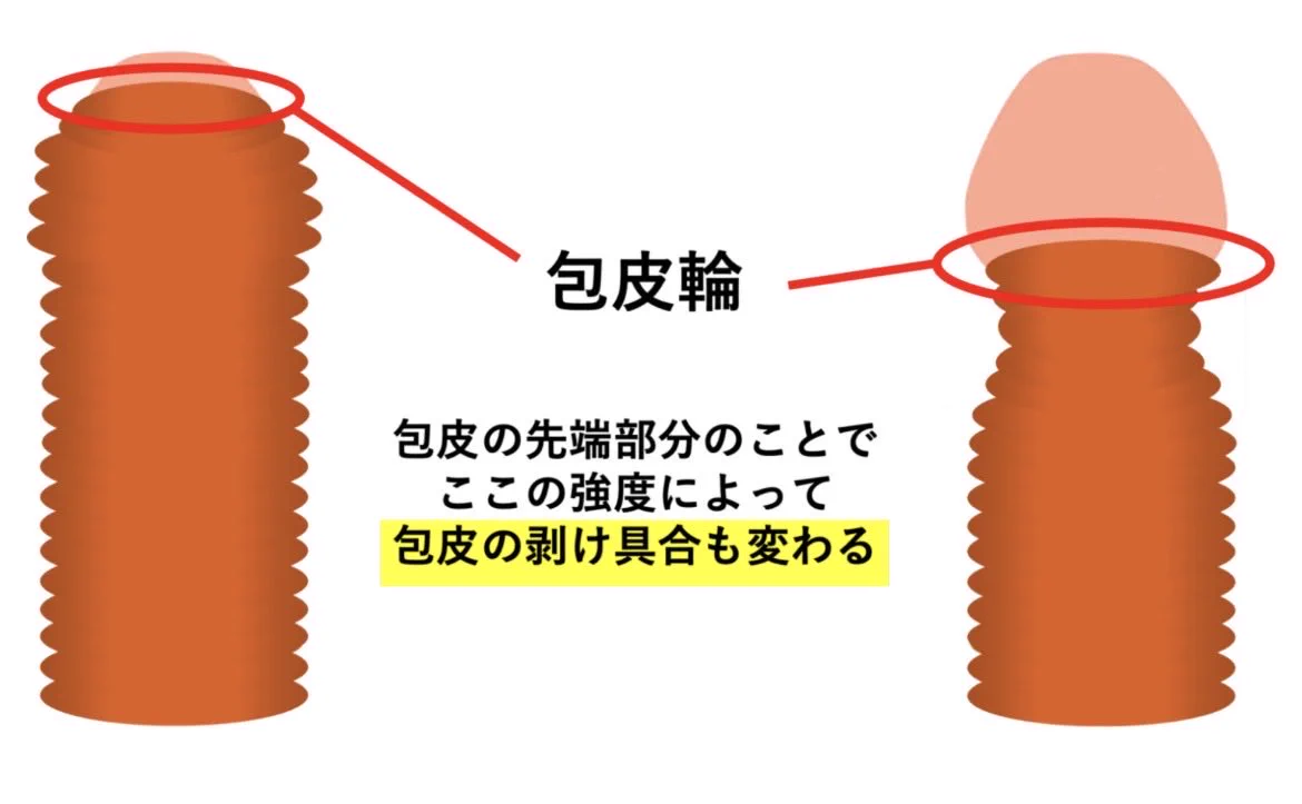 包皮 輪 狭窄