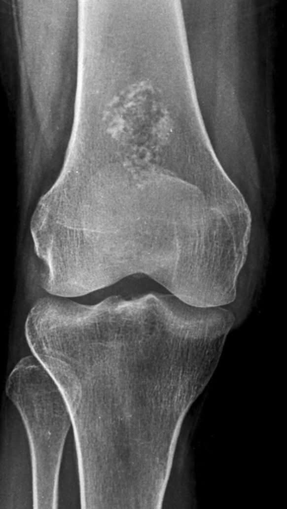 hemo_shk's tweet image. Diagnose the lesion on this X-ray ?🩻

#Orthopedics #XRay #Tumors #Health