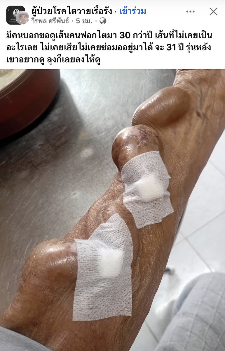 คนที่ต้องฟอกไตจะมีแบบนี้ทุกคนไหมอะครับ แล้วมันเกิดจากอะไร เห็นแล้วต้องดูแลตัวเองสุขภาพเยอะๆอย่าให้ต้องฟอกไตเลย😓