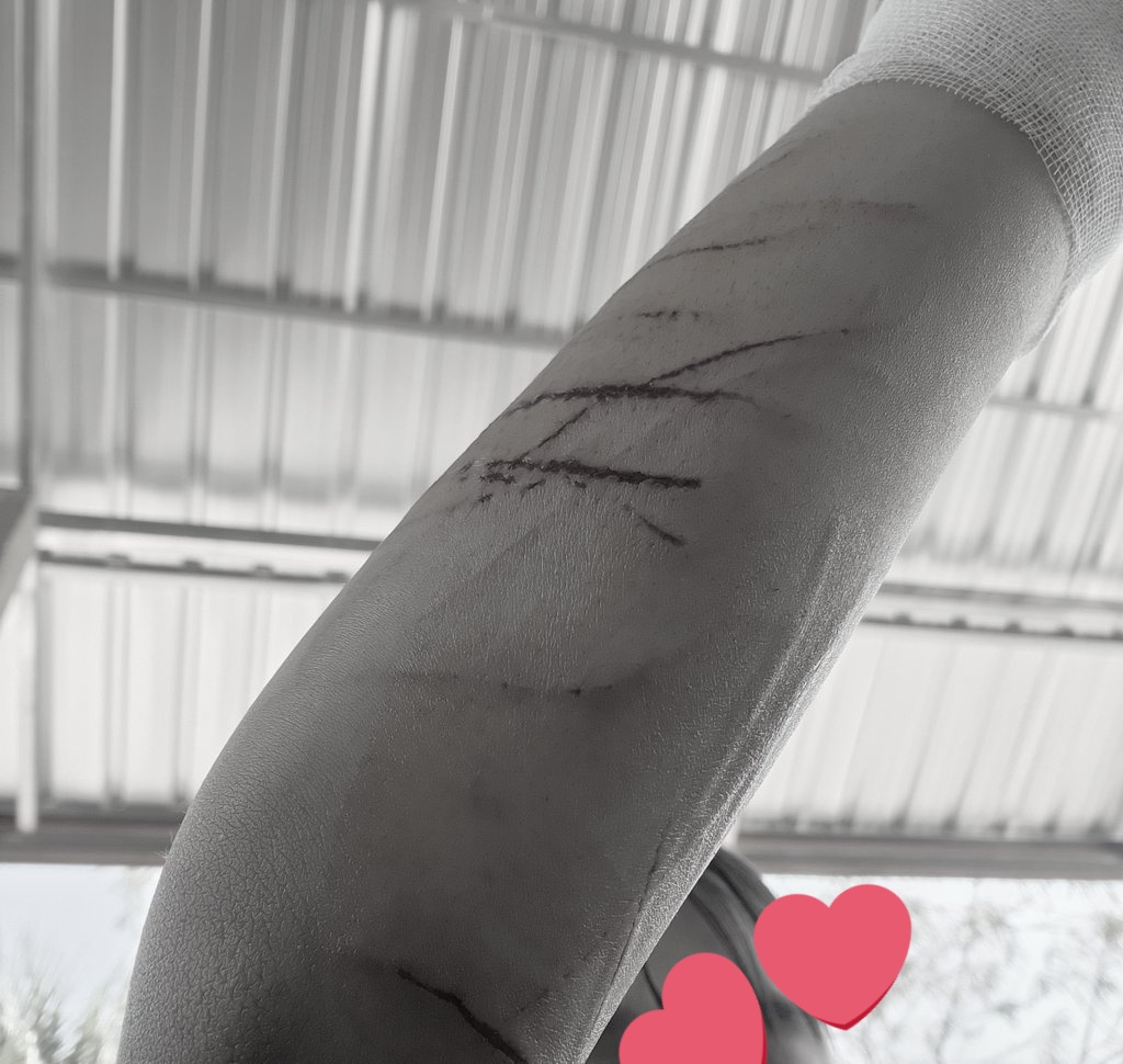 tamthamz's tweet photo. นี่คือแผลที่เห็นตอนแรก กับ แผลที่พึ่งเห็นตอนกดถ่ายรูป🥲
ตอนนี้แผลหายแล้ว ทิ้งไว้แค่ลอยแผลเป็น เต็มแขนเลยยยยย https://t.co/79DERLENy1