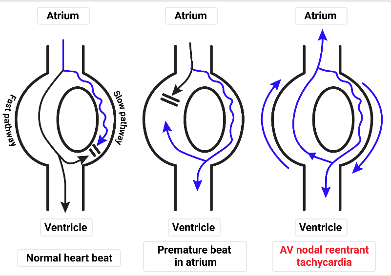 BodyExplained's tweet photo. 🫀Good depictions of reentry circuits that can cause some issues in the heart https://t.co/UAhervDXaa