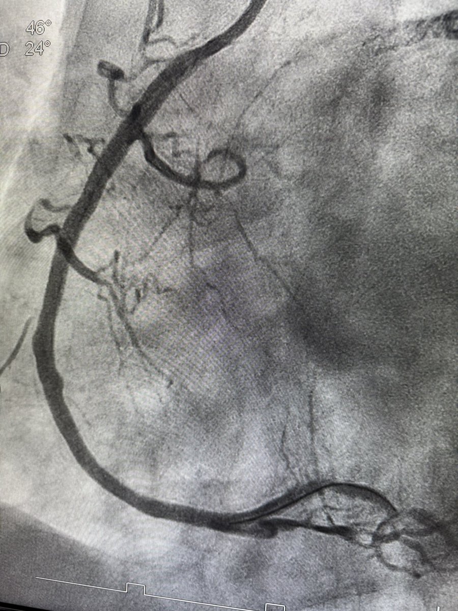 Nih yang dah berobat ke sana sampai 3x katanya tidak perlu dilakukan tindakan pasang stent/ring…suruh kontrol mulu dengan biaya pribadi sampai akhirnya serangan jantung acs stemi inferior…langsung gue kerjain malam-malam…dan ketika di sini dia pakai BPJS kelas 3…
Berapa