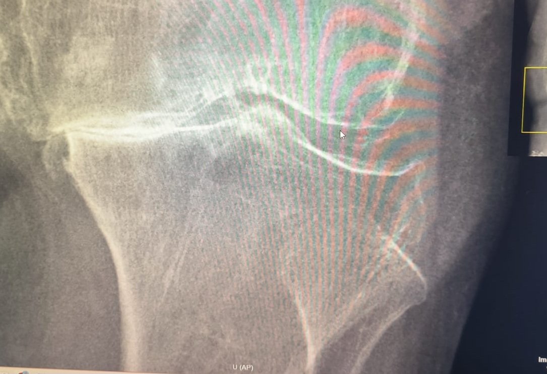ConsejosReumato's tweet photo. La enfermedad por cristales de  #pirofodfstocálcico ocasiona ataques de #seudogota y también hallazgos radiológicos como la #condrocalcinosis que se ve en la RX de #rodilla . La TEM de #tórax además revela condrocalcinosis en el #hombro derecho. #pseudogout #knee #chest #CPPD https://t.co/gfMRD4HSqY