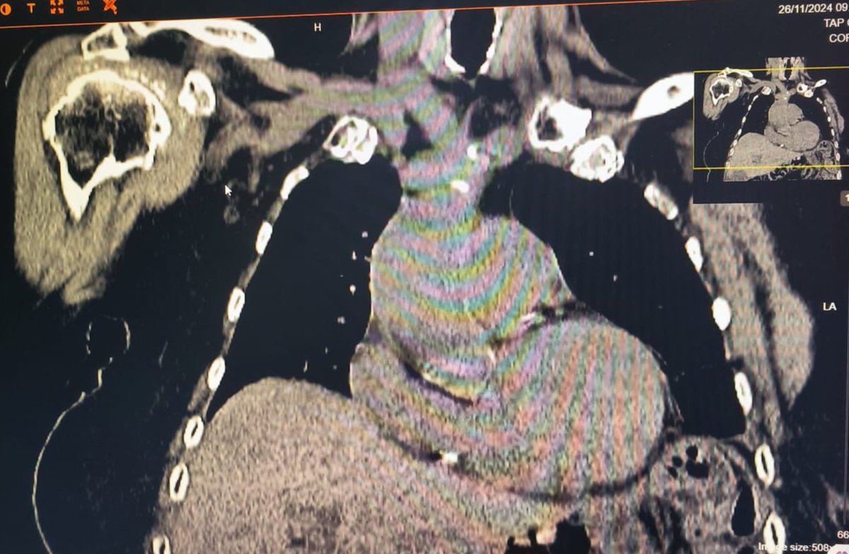 ConsejosReumato's tweet photo. La enfermedad por cristales de  #pirofodfstocálcico ocasiona ataques de #seudogota y también hallazgos radiológicos como la #condrocalcinosis que se ve en la RX de #rodilla . La TEM de #tórax además revela condrocalcinosis en el #hombro derecho. #pseudogout #knee #chest #CPPD https://t.co/gfMRD4HSqY