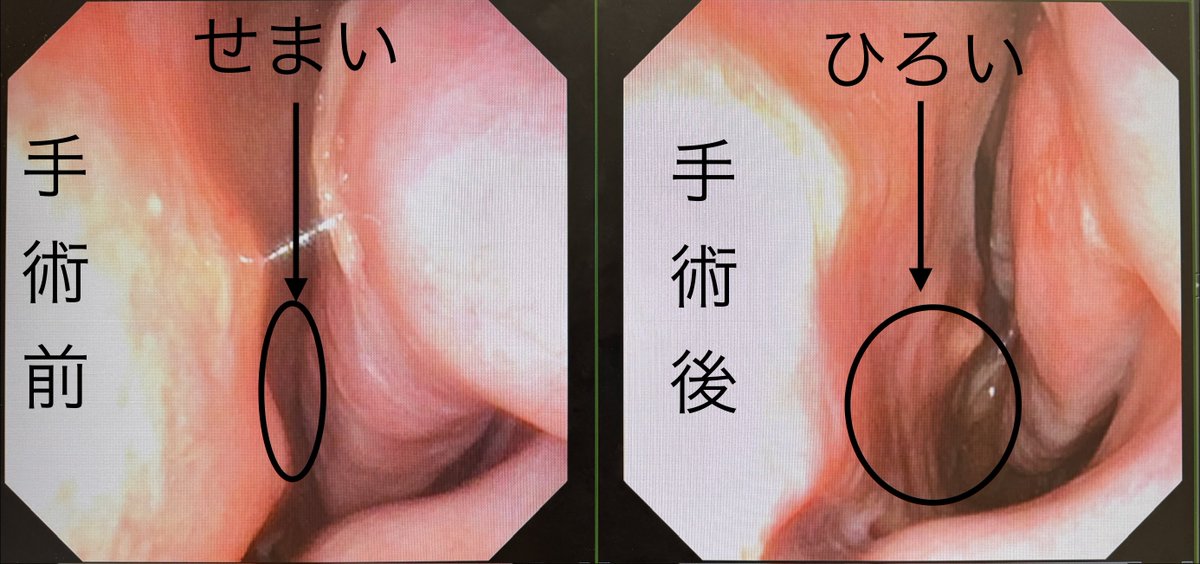 鼻づまりは手術で改善できます。
効果は永続的です。抗アレルギー薬が効かない、飲みたくない方。レーザー手術を受けようか悩んでいる方は是非ご相談を。