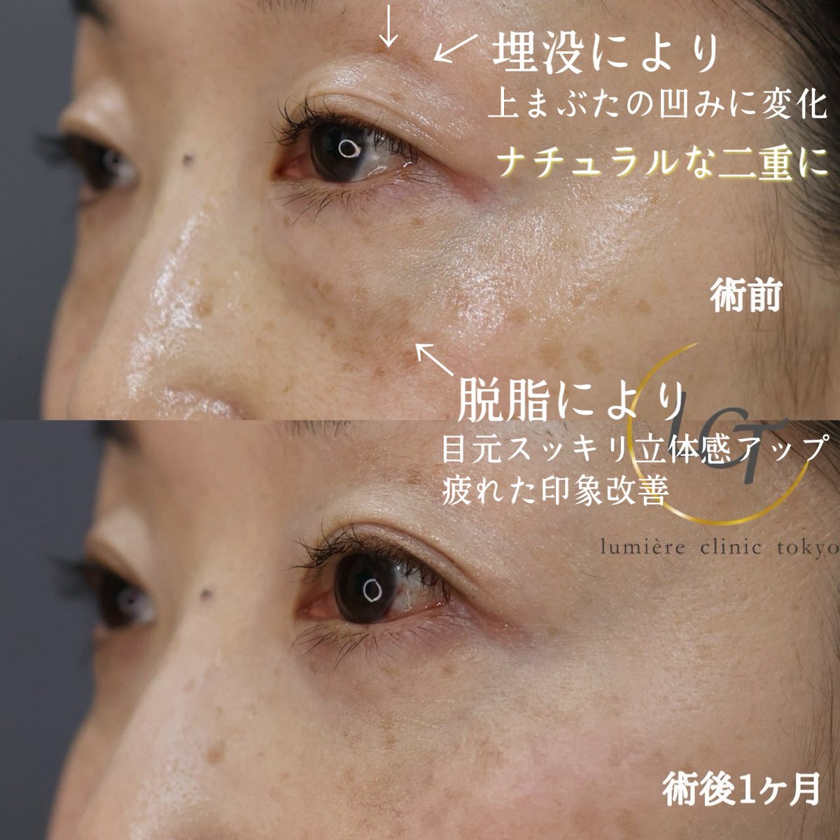 重い目元の変化！
埋没と経結膜脱脂にて、目の開きや目元の印象が変わりました😌

形成外科専門医による施術のため安心してお任せして頂けます‼︎
細かいデザイン&amp;術中の確認による微調整を行い、ご希望とする目元へ✨

６月末までのご予約可能🙆
lumiere---clinic.com